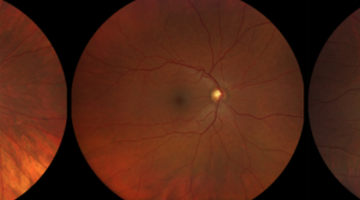 Close-up image of retinal pigmentation