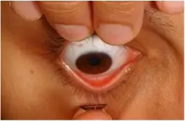 Fingers pulling eyelids up with an eye looking down about to insert a contact lens