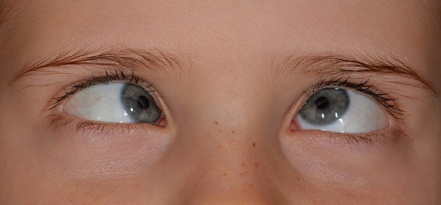 A child with strabismus