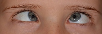 Child's eyes affected by strabismus