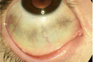 Some children can have larger grey or brown flat patches on the white of the eye.