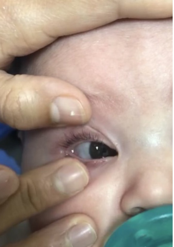Placing a contact lens on a baby's eye