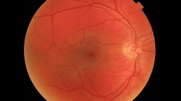 Cascader Retinal Image