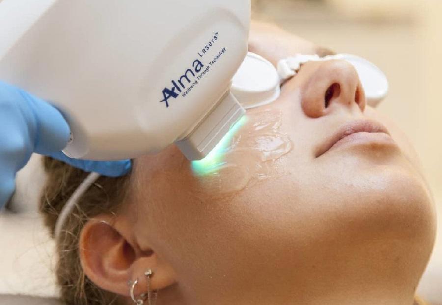 IPL Treatment 