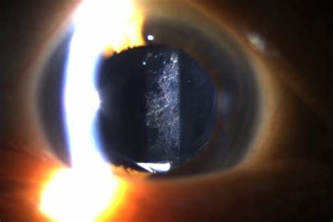 Close up YAG, with a think vertical beam of light shining into an eye