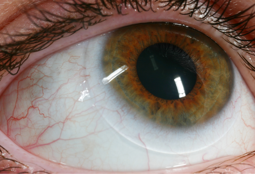 An eye with contact lens