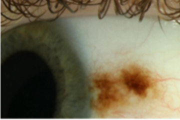 The naevus on an eye with a lot of melanin pigment