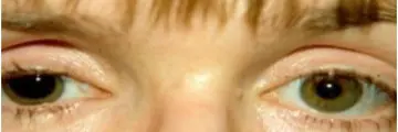 Image of dilated eye with a large pupil