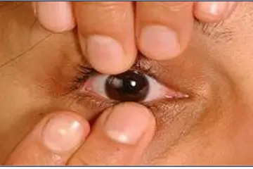 Photo showing method 1 of contact lens removal