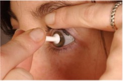 Photo showing method 3 of contact lens removal