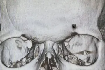 Photo of an X-ray image of bullet
